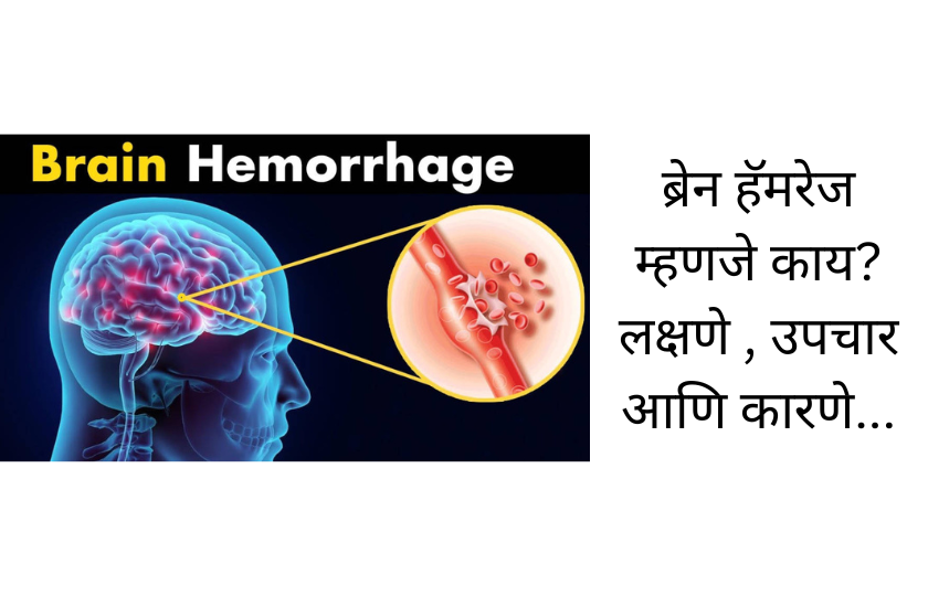 ब्रेन हॅमरेज म्हणजे काय? लक्षणे , उपचार आणि कारणे